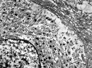 F,17y. | neck - rhabdomyosarcoma